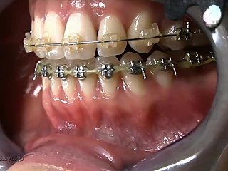 Japanese braces girl